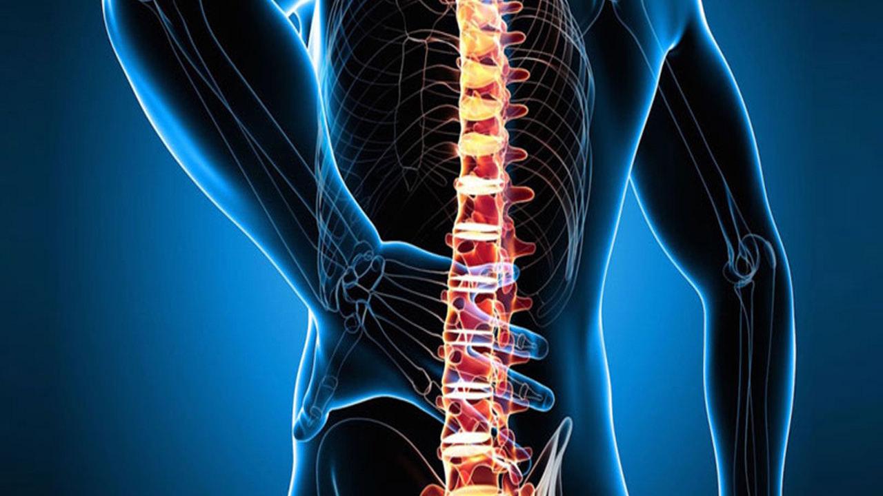 Skolyoz nedir,  belirtileri nelerdir? Skolyoz hastalarının görüntüsü ve tedavisi...