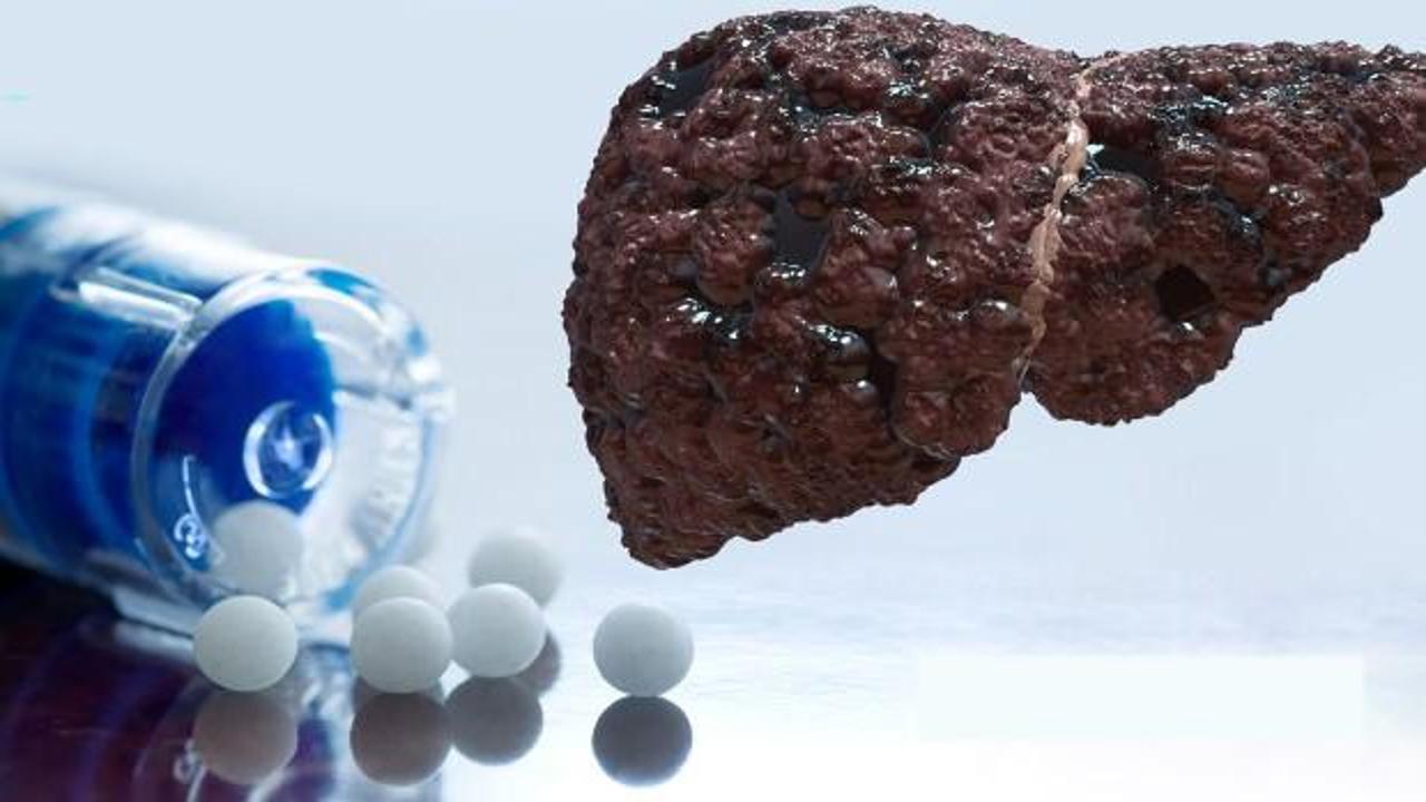 Siroz hastalığı neden olur, belirtileri nelerdir? Siroz hastalığı tedavisi var mı, ölümcül müdür?