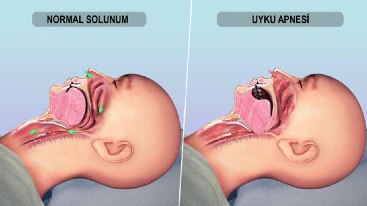 Uyku apnesi nedir, belirtileri nelerdir? Uyku apnesi neden olur, tedavisi nedir?