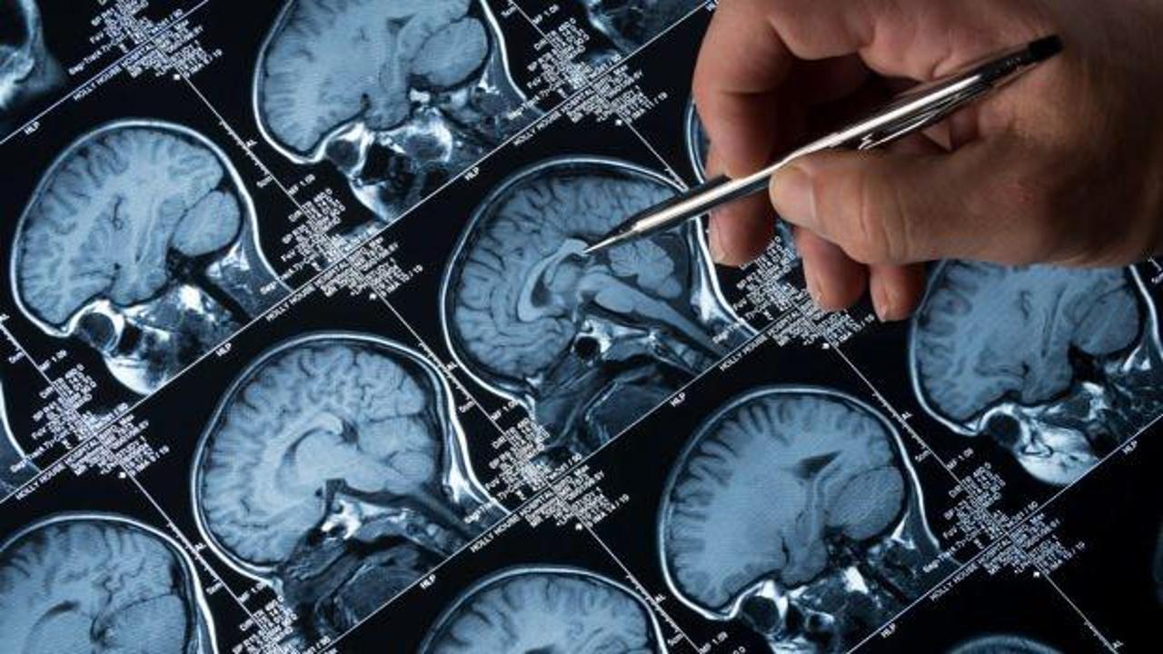 Demansa iyi gelen yiyecekler: Beyin sağlığını destekleyen 3 önemli besin!