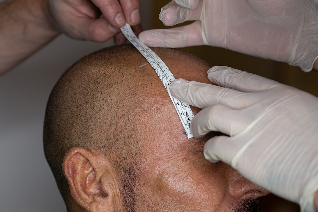 Clinista Saç Ekim Merkezi’nde Saç Ekimi: Rahat ve Güvenli Süreç